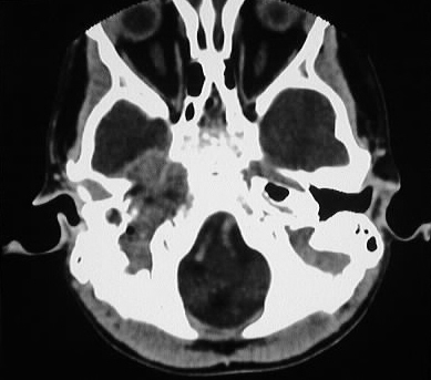 Rhabdomyosarcoma